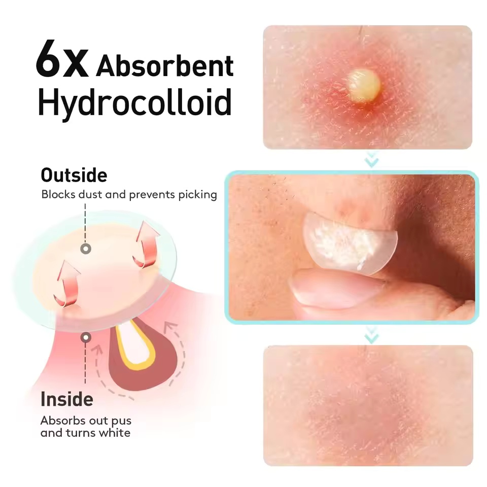 แผ่นแปะสิว 360 ชิ้น/กล่อง - ปร - Skincare The Originote บทวิจารณ์และราคา
